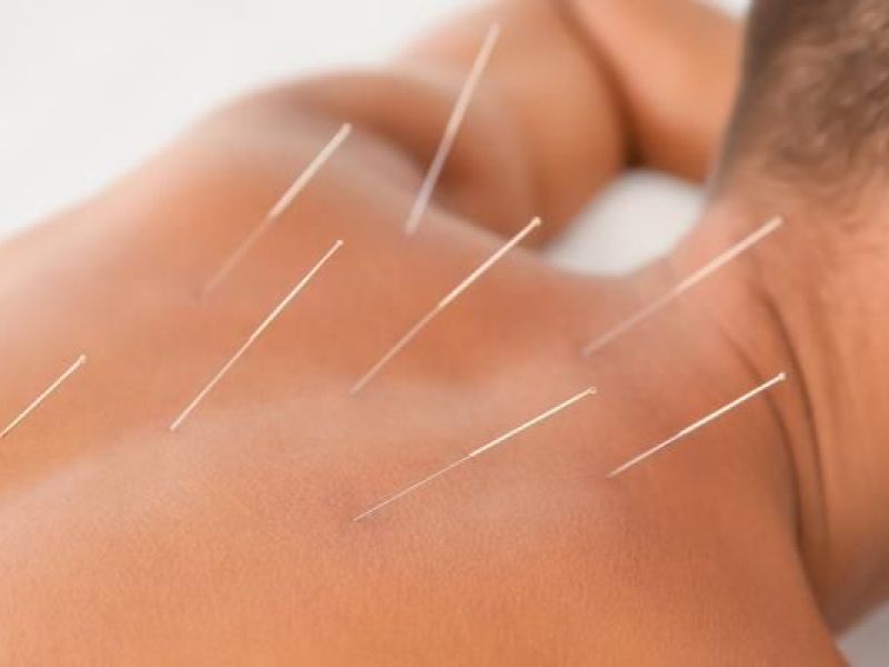 Спец. физиотерапевт Блаже Арсов не запознава што значи Dry needling терапија и за што се употребува